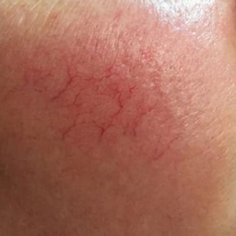 Da mỏng lộ mao mạch là gì? Nguyên nhân, cách khắc phục hiệu quả 