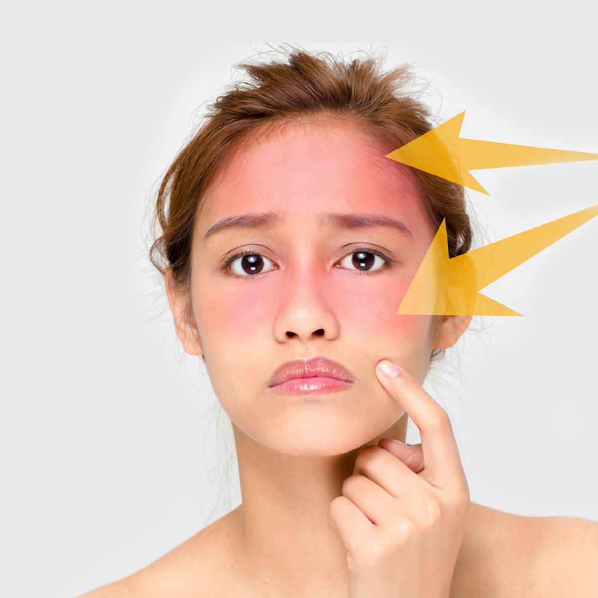 Mặt mụn có nên dùng kem chống nắng không?