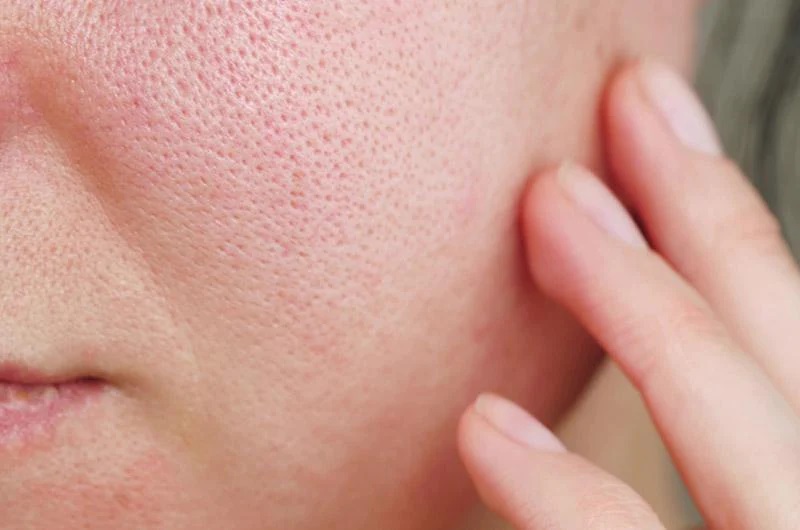 Rửa mặt bằng nước lạnh có hết mụn không?