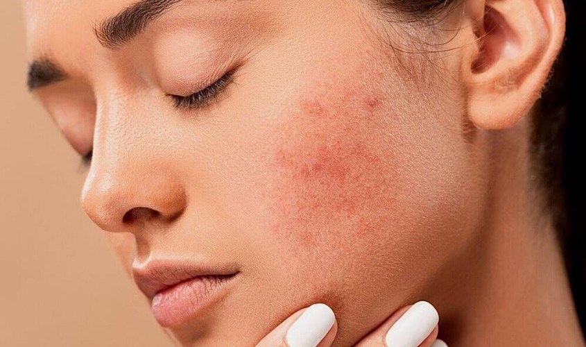 Tại sao bôi kem chống nắng bị ngứa? Nguyên nhân do đâu?