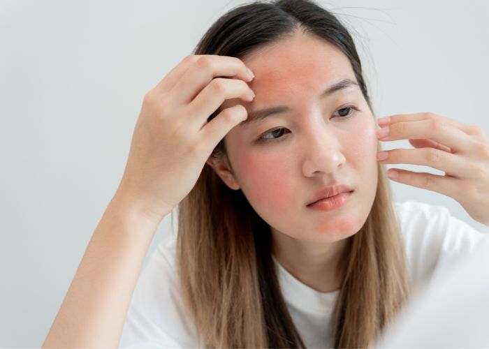 Dùng kem chống nắng bị nóng mặt? Lý giải nguyên nhân và cách khắc phục