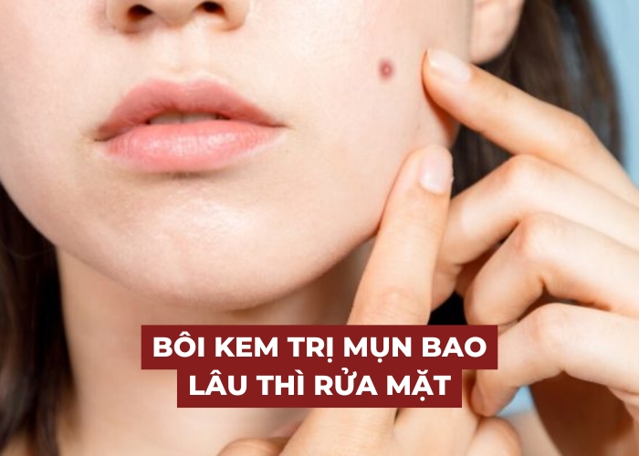 Giải đáp câu hỏi: Bôi kem trị mụn bao lâu thì rửa mặt?