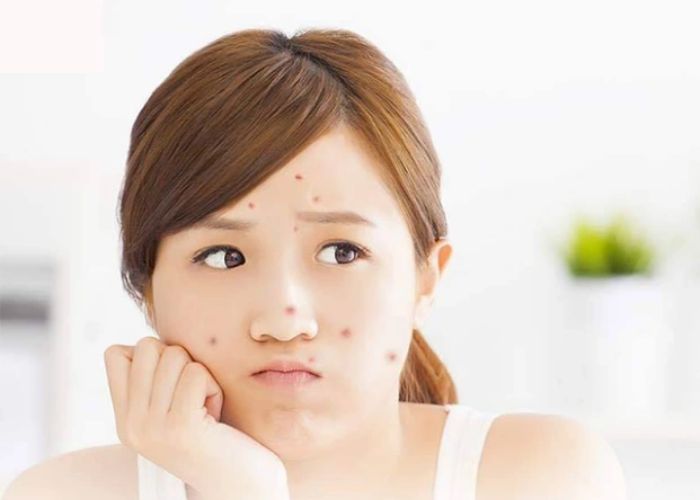  Cách chọn kem dưỡng ẩm Hàn Quốc cho da mụn