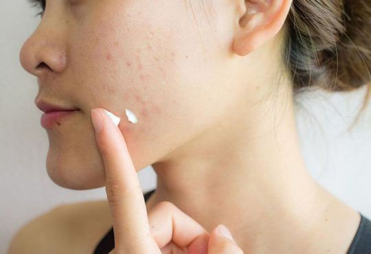Mụn sưng viêm thì sử dụng chấm mụn nào tốt