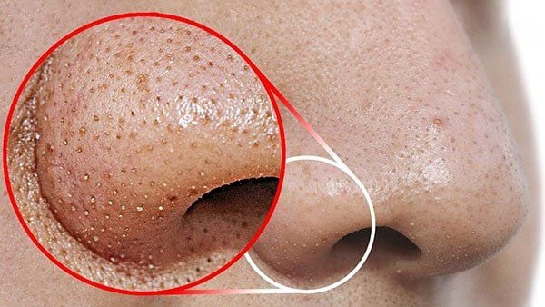 Tẩy tế bào chết KOR có giúp giảm mụn đầu đen