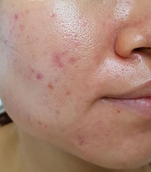 Da dầu có nên dưỡng ẩm không? Bí quyết kiểm soát dầu thừa hiệu quả cho mùa hè