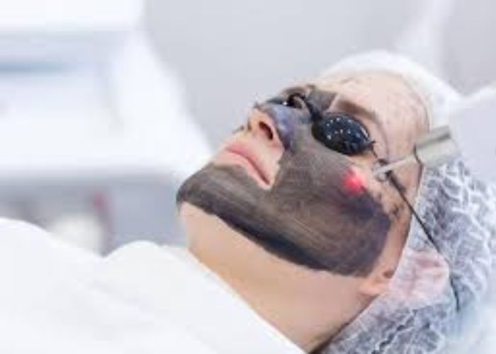 Ai phù hợp với liệu trình Carbon Laser và ai nên cân nhắc