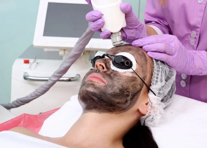 Carbon Laser là gì? Liệu trình “lột xác” da dầu, mụn ẩn được săn đón nhất hiện nay