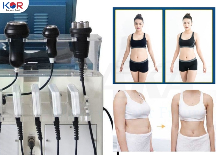 Cavitation là gì? Giải mã công nghệ giảm mỡ bằng sóng siêu âm hiệu quả