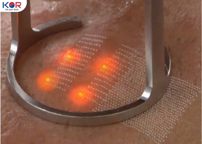 Laser Fractional CO2 là gì? Công nghệ tái tạo da trị sẹo rỗ và cách chăm sóc đúng