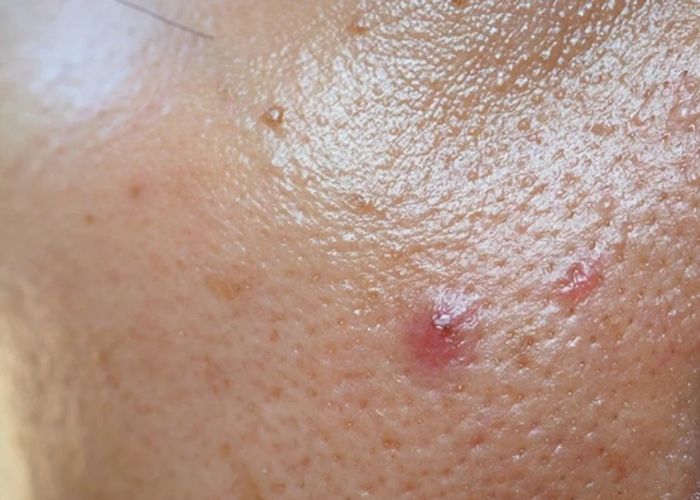 Vai trò của nước ép trong việc cải thiện da dầu