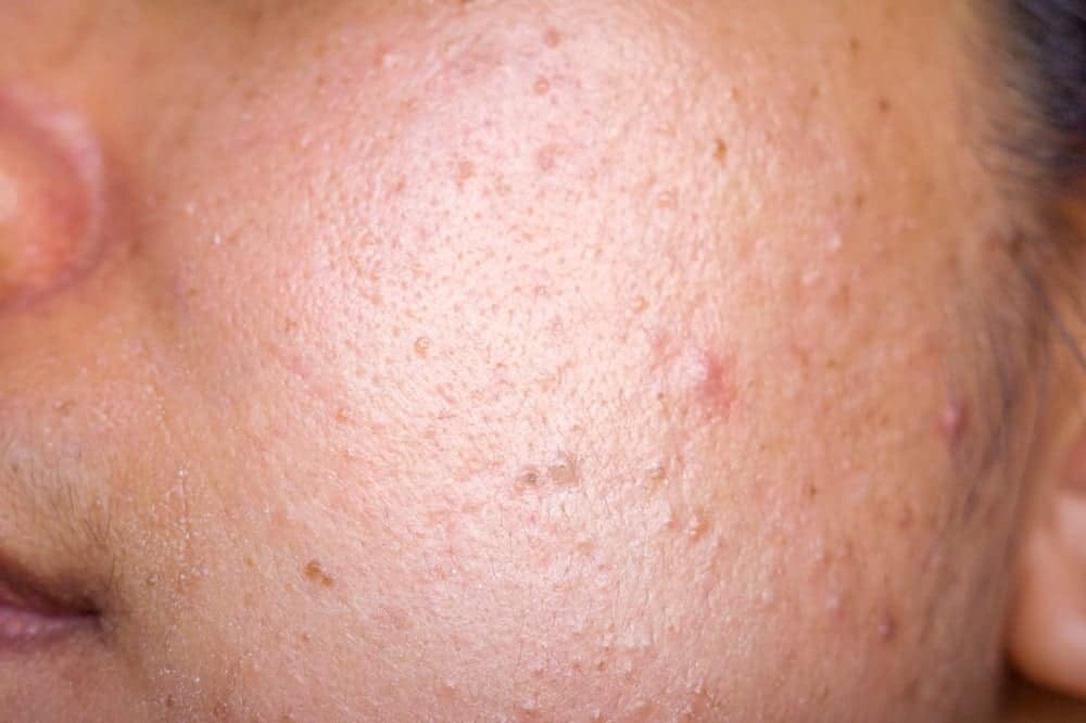 Nguyên nhân da sần sùi, hướng dẫn cách chăm sóc để da luôn mềm mịn