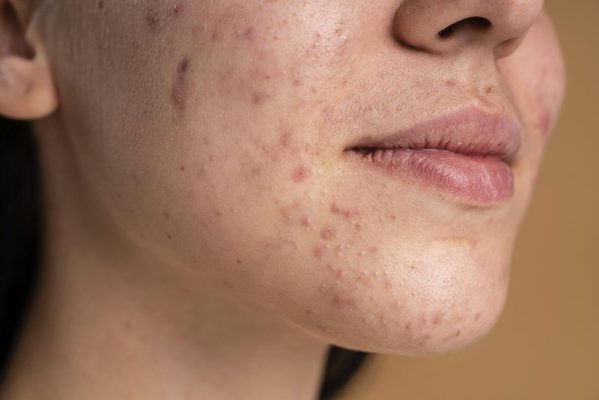 Nguyên nhân gây thâm mụn – hiểu rõ để trị tận gốc