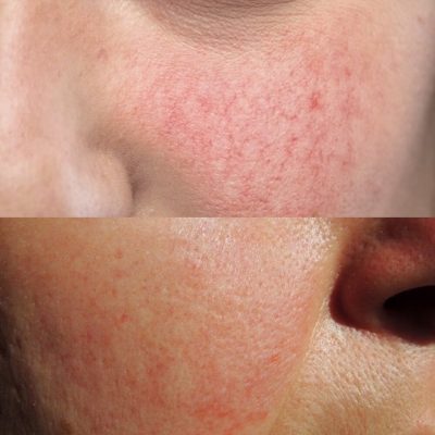 Vì sao skincare bị rát? Cách nhận biết phản ứng bình thường hay kích ứng