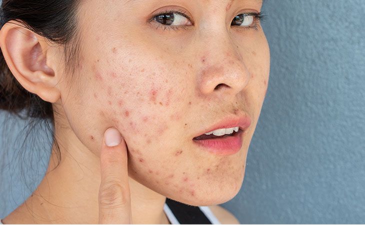 Lợi ích và rủi ro khi treatment cho da dầu mụn