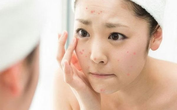 Khi nào da dầu mụn nên treatment