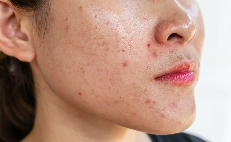 Những nhóm treatment thường dùng cho da dầu mụn