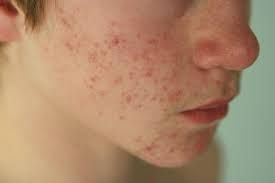 Những sai lầm phổ biến khiến da "toang" khi treatment