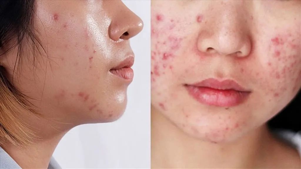 Các loại hoạt chất phù hợp cho da dầu mụn mới bắt đầu