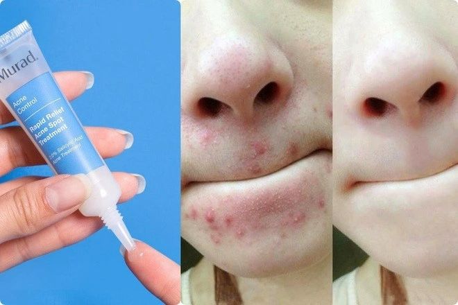 Cơ chế cải thiện mụn trứng cá của Zinc trong mỹ phẩm