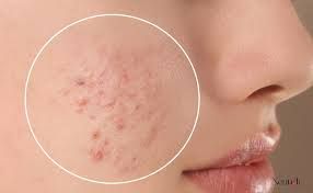 Những sai lầm thường gặp khi sử dụng hoạt chất trị mụn