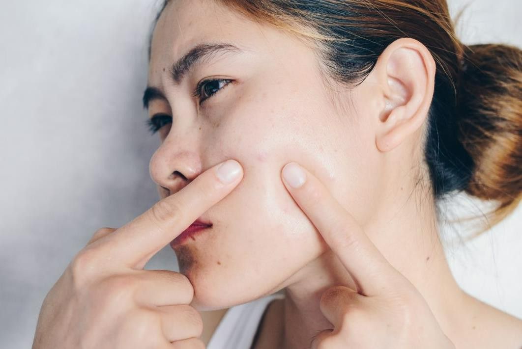 Cách chọn thành phần trị mụn theo từng tình trạng da