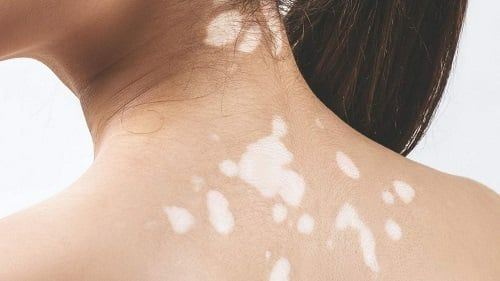 Nguyên nhân da xuất hiện đốm trắng nhỏ và cách khắc phục hiệu quả tại nhà