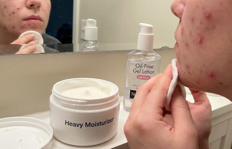 Mẹo khắc phục tình trạng bị nổi mụn khi sử dụng kem dưỡng ẩm