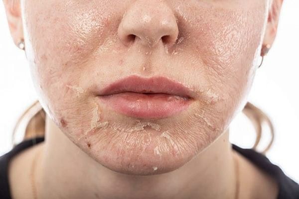 Peel da xong dùng BHA được không? Thời điểm vàng để tái sử dụng