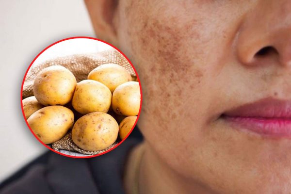 Ưu và nhược điểm của cách trị sẹo thâm tự nhiên bằng khoai tây