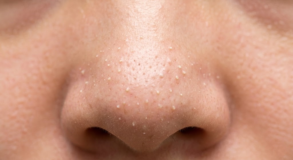 Mụn cám gì? Dấu hiệu nhận biết và cách điều trị hợp lý