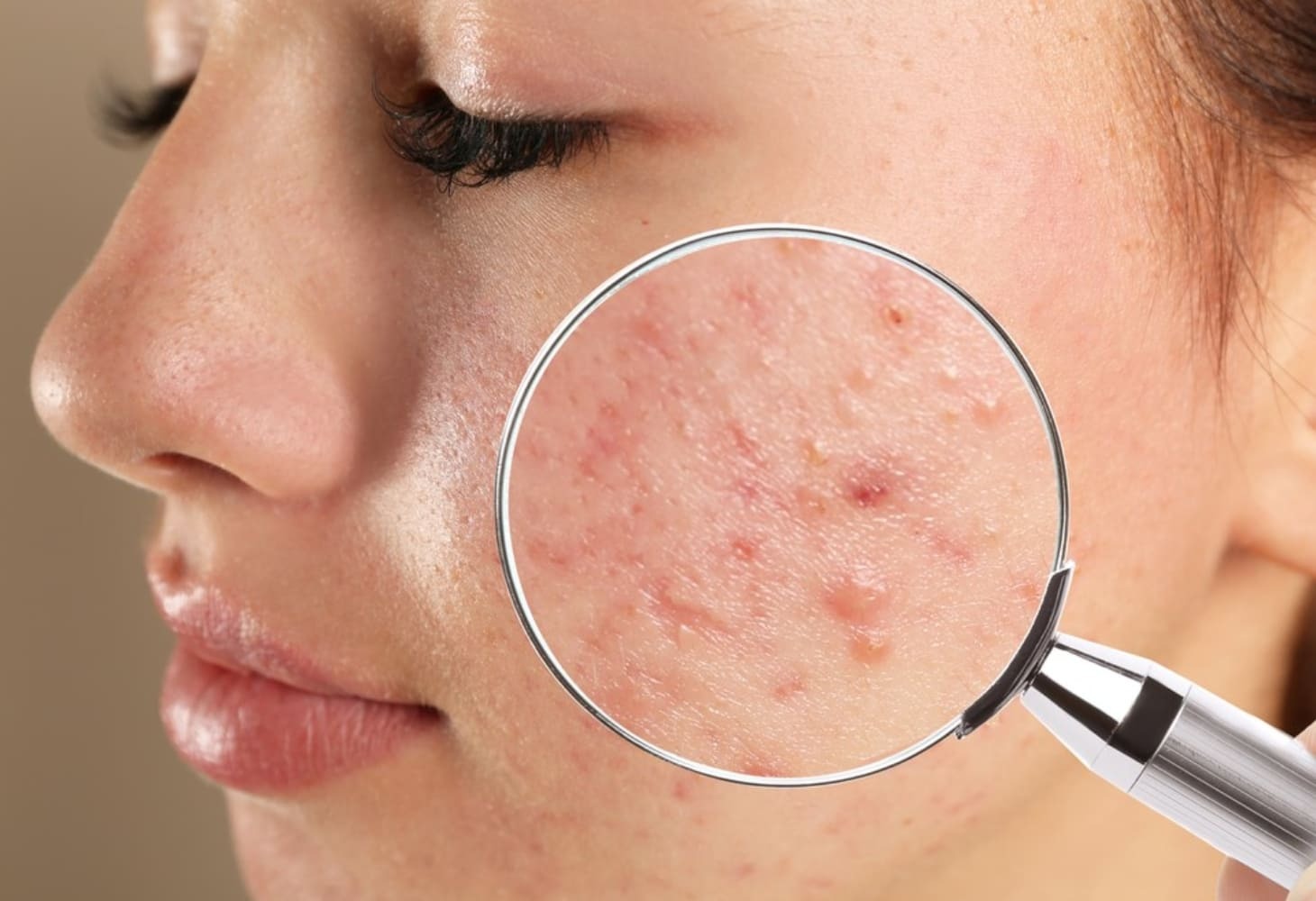 Mụn li ti: Nguyên nhân và cách điều trị mụn nhỏ li ti