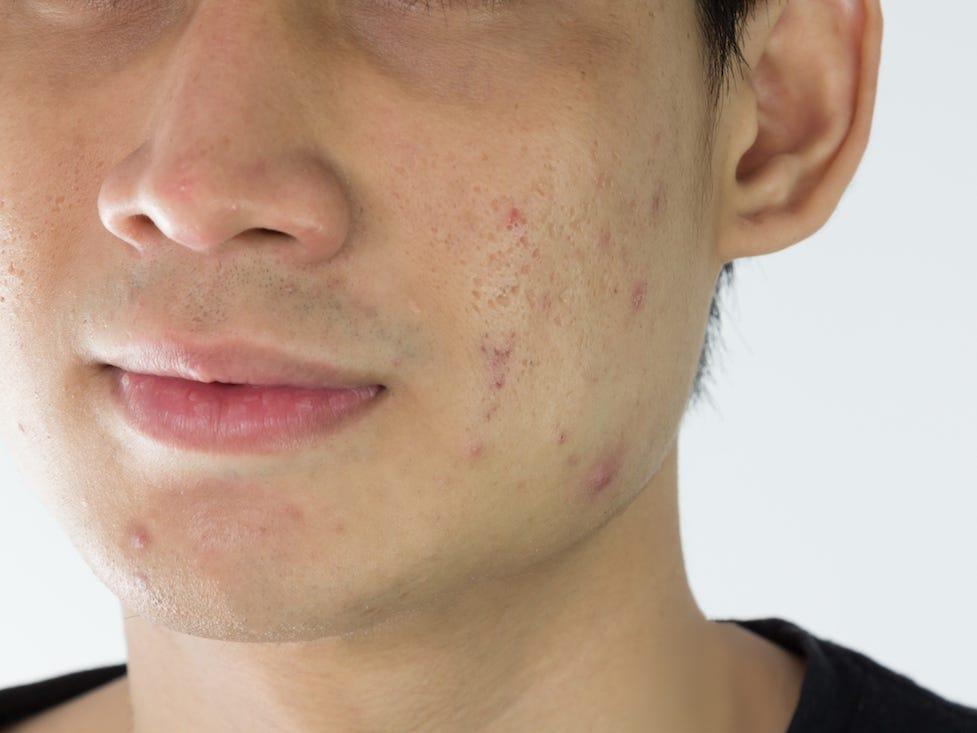 Vì sao Nam giới cần xử lý mụn bằng cách này thay vì dùng kem bôi hay đi Spa như con gái? 