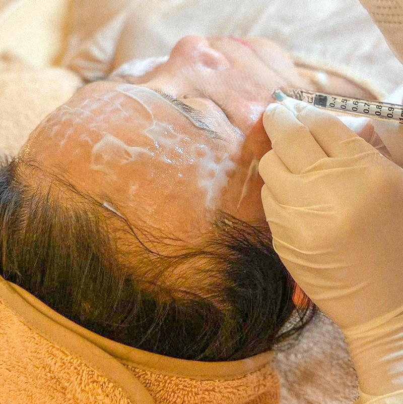 Mesotherapy – Hết sẹo mụn tận gốc, an toàn, hiệu quả , Có Nên Thử? 
