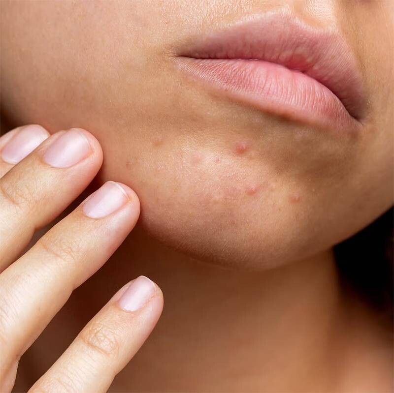 Cách trị mụn cám và mụn ẩn triệt để, không lo bị thâm sẹo, làn da mịn màng 