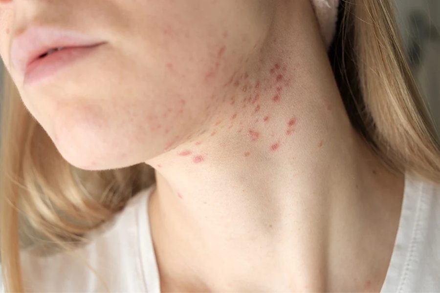 Mụn Ở Quai Hàm: Nguyên Nhân, Dấu Hiệu Và Cách Điều Trị 