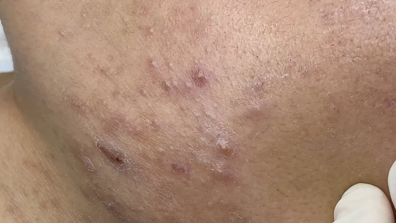 Mụn Cứng Dưới Da: Đặc Điểm, Nguyên Nhân, Cách Điều Trị