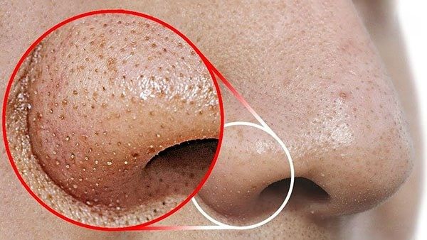Bí kíp tiêu diệt mụn ẩn và mụn đầu đen tận gốc
