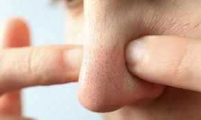 Mụn ẩn nằm sâu dưới da