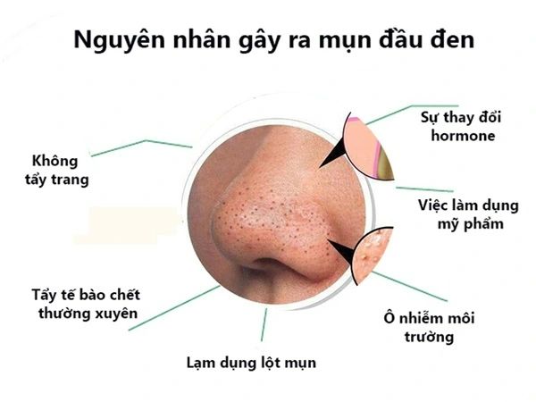 Nguyên nhân khiến mụn đầu đen tái phát liên tục