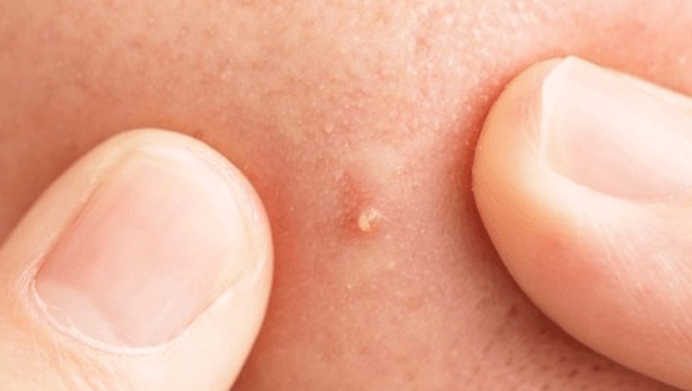 Mụn bọc có tự hết không ? Cách xử lý mụn bọc hiệu quả 