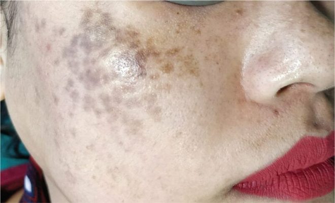 Những nguyên nhân nám phổ biến bạn cần biết