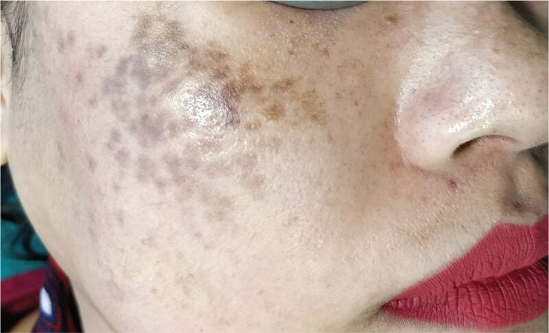 Nám chân sâu là gì? Nguyên nhân và cách điều trị dứt điểm