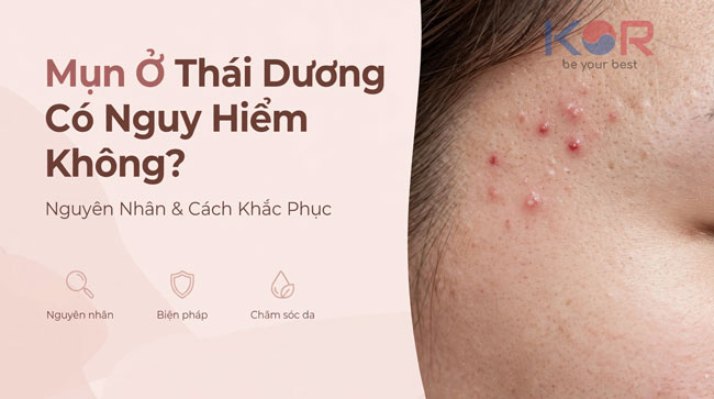 Mụn Ở Thái Dương Có Nguy Hiểm Không? Nguyên Nhân & Cách Khắc Phục
